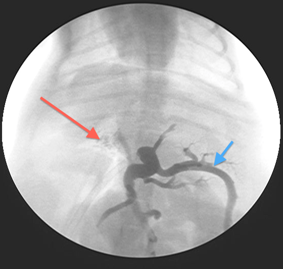 Portovenogram following test ligation